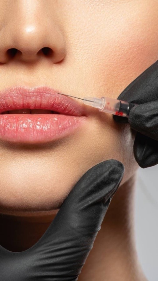 Hyaluron-Lippenunterspritzung für natürlichen Lippenaufbau