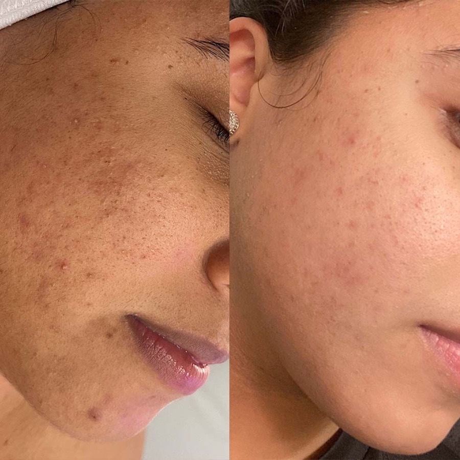 Medizinisches Peeling gegen Pigmentflecken und Unreinheiten