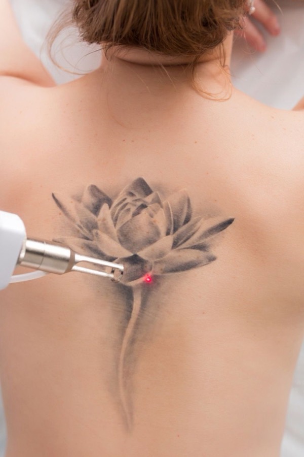 Tattoo-Entfernung mit Laser bei Riverside Beauty
